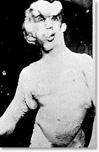 Deformation von Joseph Merricks Körper 